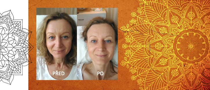 dvě fotografie téže ženy před a po kosmetickém ošetření